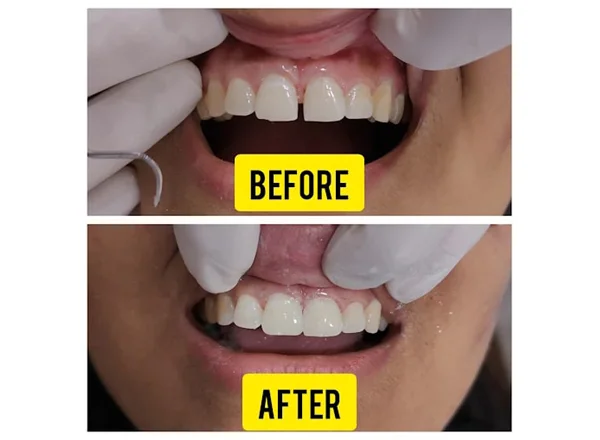 Before and After