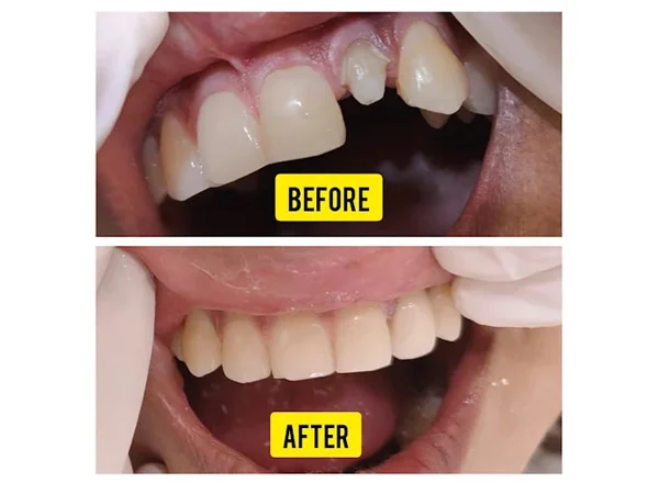 Before and After