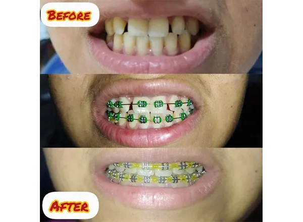 Before and After