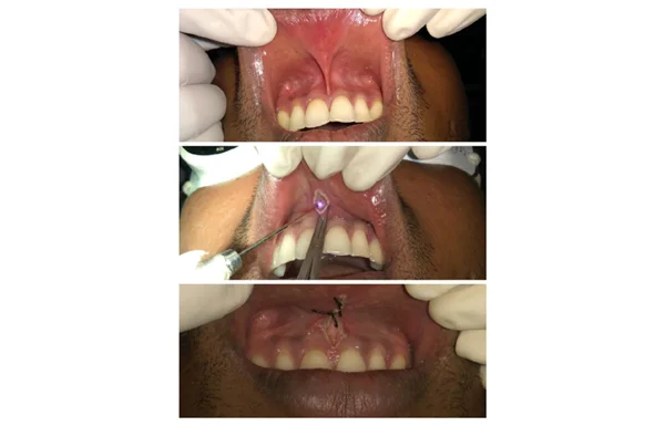 Laser Surgeries Extraction